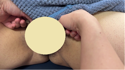 精索テクニック1